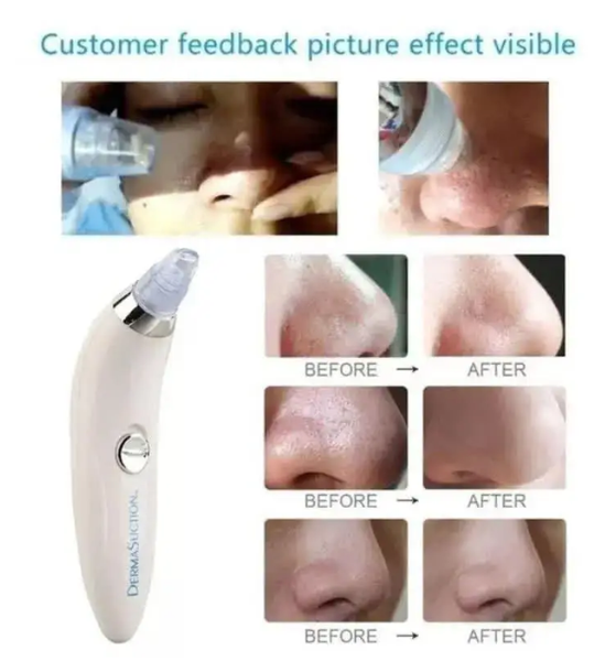 Вакуумный очиститель пор от черных точек Derma Suction 0262 фото