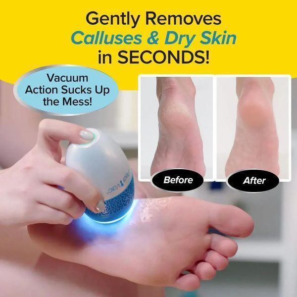 Акумуляторна пемза Remove Calluses для ефективного видалення мозолів та догляду за п&rsquo;ятами 0784 фото